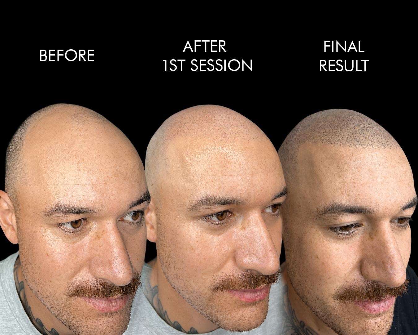 Before, after first session, and final result scalp micropigmentation transformation