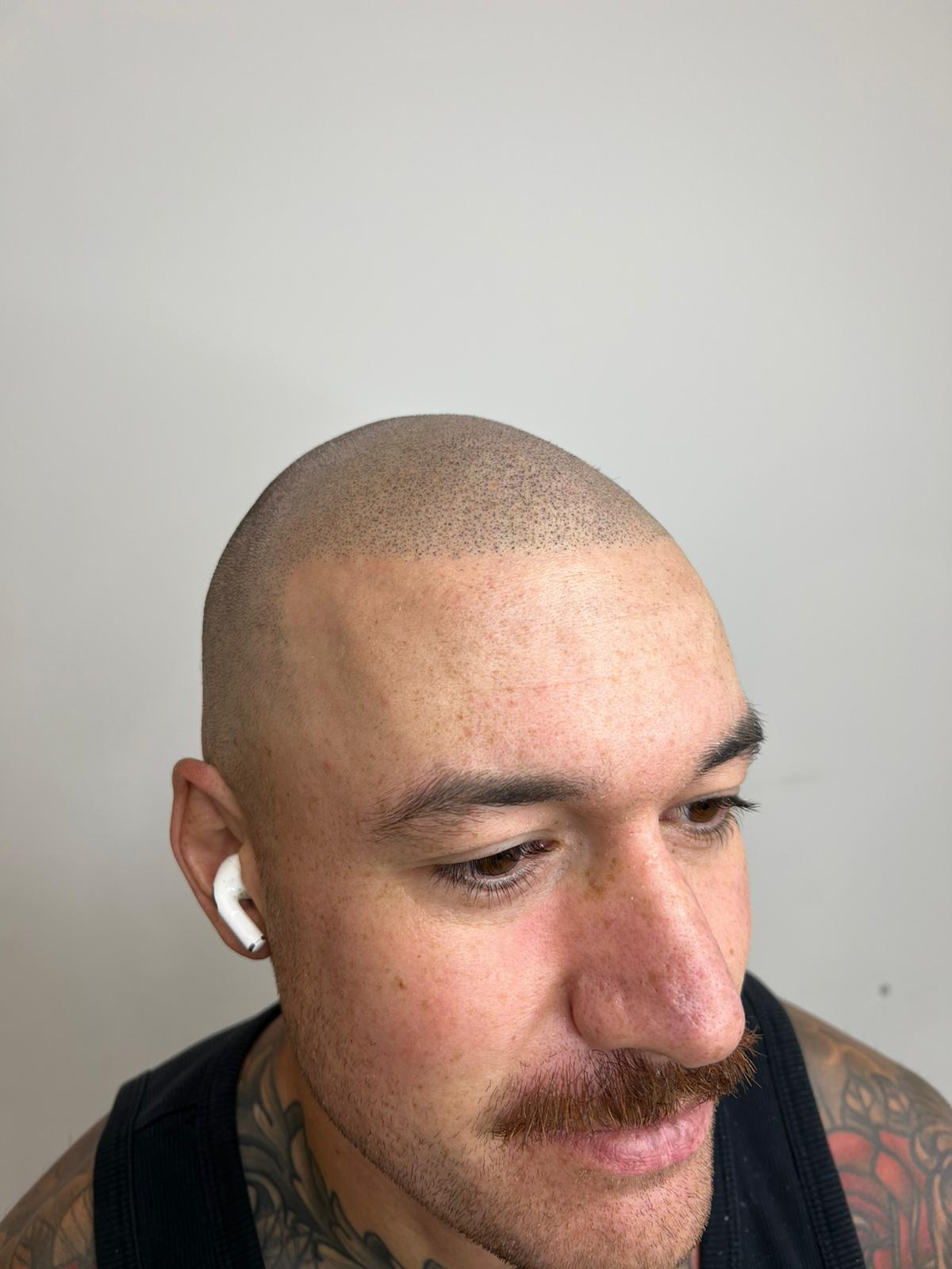 Hairline Restoration