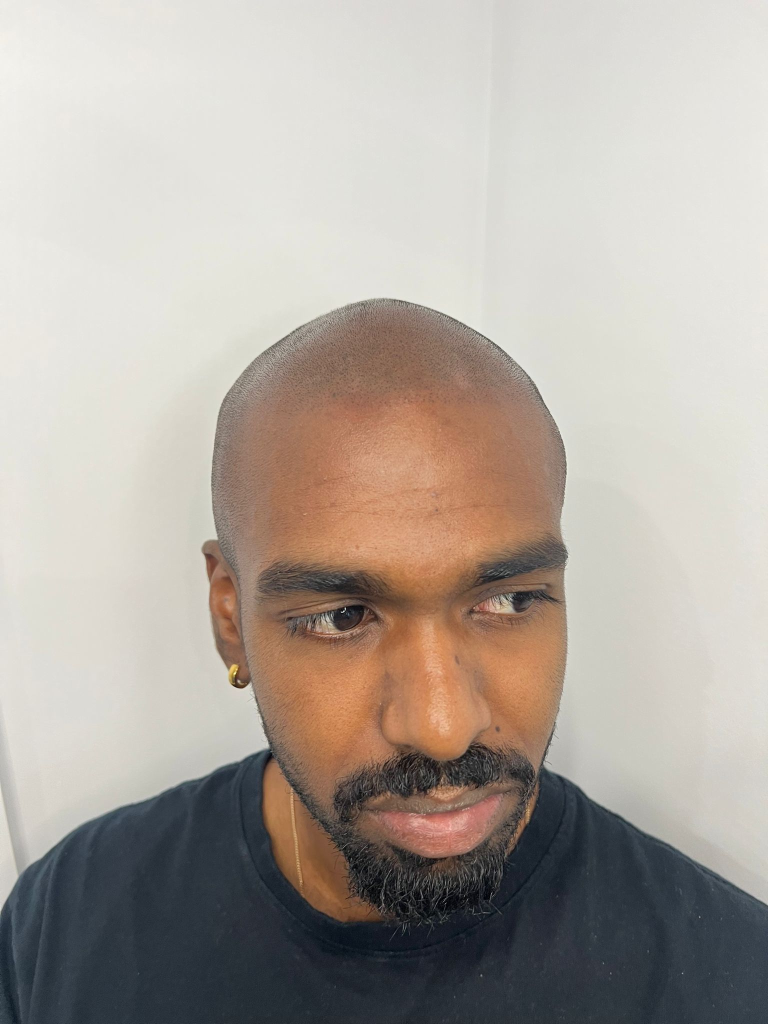 Full Scalp SMP